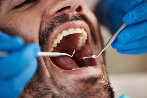 Best Emergency Wisdom Tooth Extraction in Chagrin Falls, OH